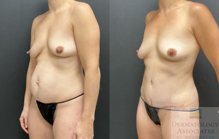 Before & After Abdominoplasty - tummy tuck Case 127 Left Oblique View in Rochester, NY
