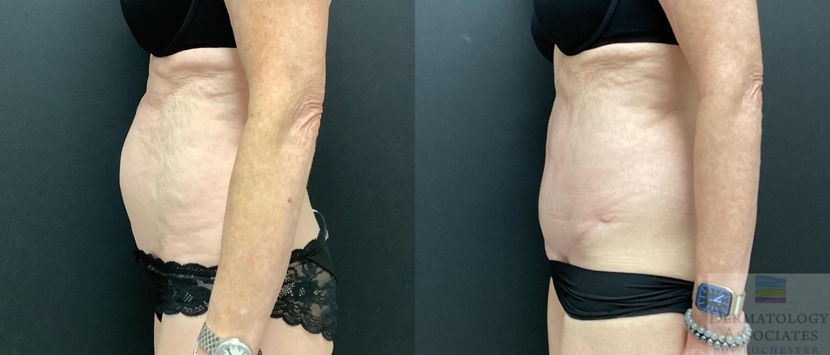 Before & After Abdominoplasty - tummy tuck Case 70 Left Side View in Rochester, NY