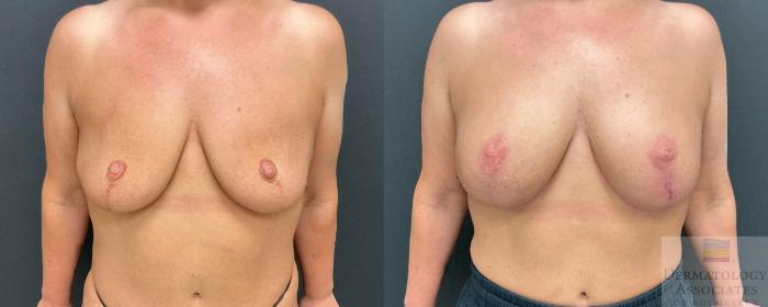 Before & After Augmentation Mastopexy - lift with implant Case 124 Front View in Rochester, NY