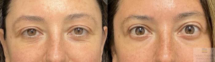 Before & After Blepharoplasty Case 133 Front View in Rochester, NY