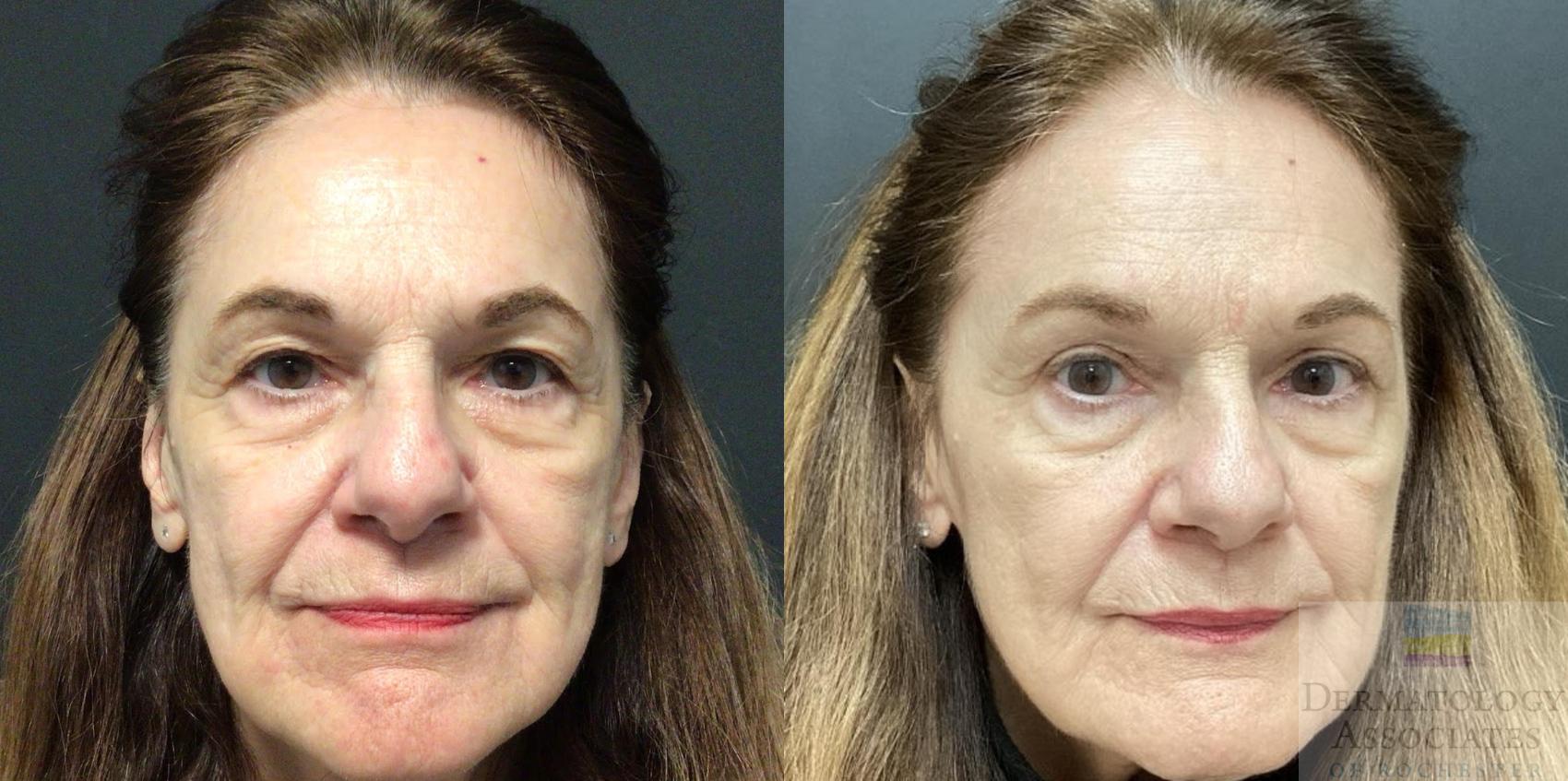 Before & After Blepharoplasty Case 72 Front View in Rochester, NY