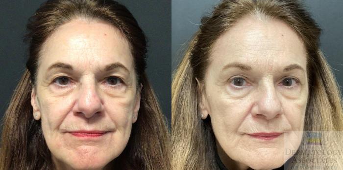 Before & After Blepharoplasty Case 72 Front View in Rochester, NY