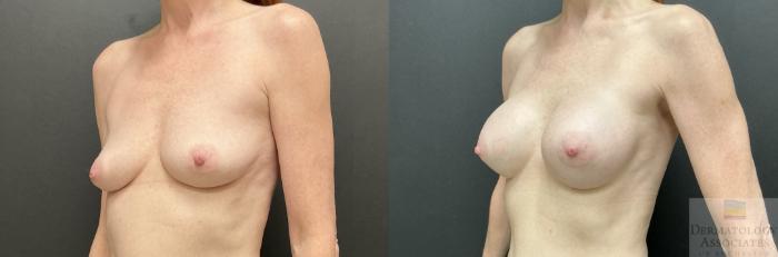 Before & After Breast Augmentation Case 131 Left Angle View in Rochester, NY