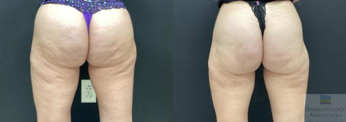 Before & After Cellulite - Aveli Case 71 Back View in Rochester, NY