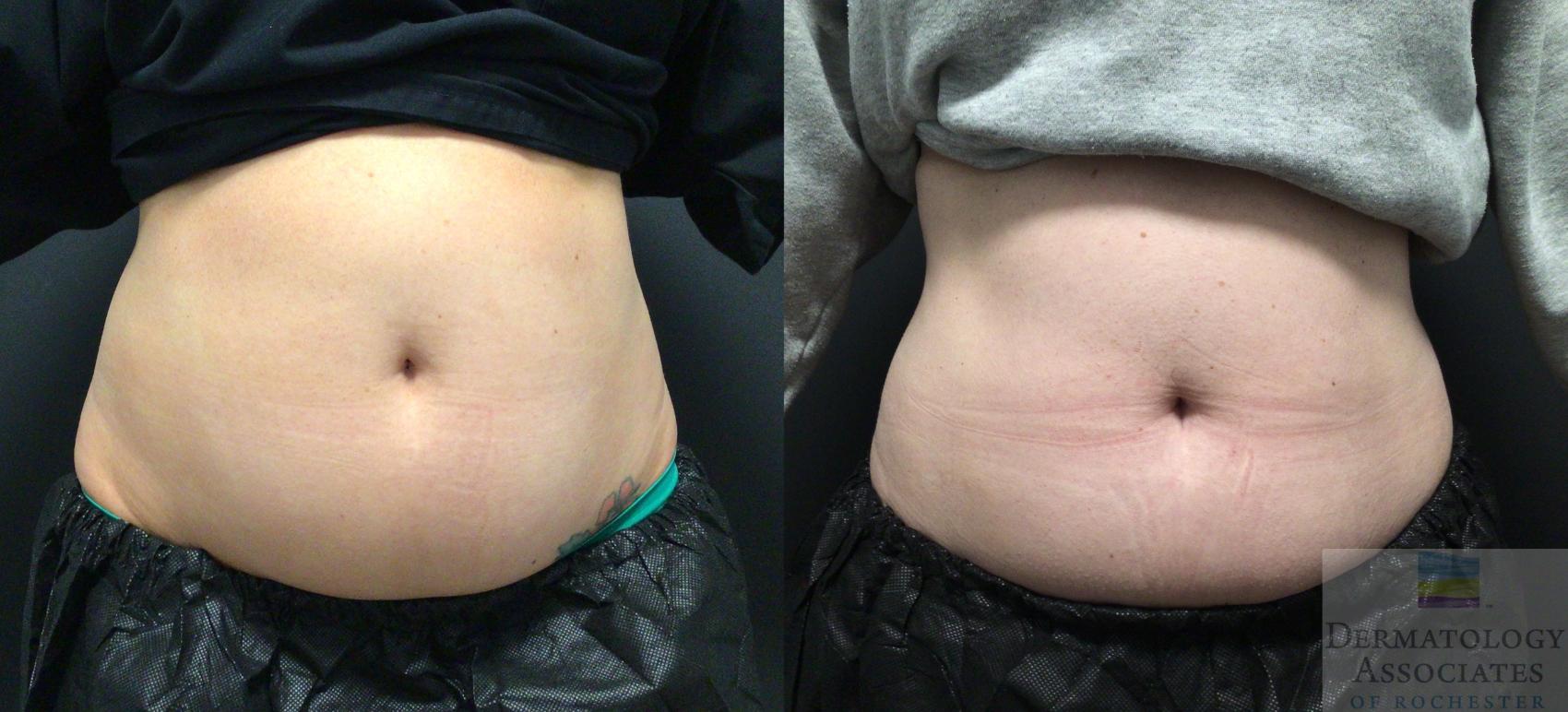 Before & After Coolsculpting Case 74 Front View in Rochester, NY
