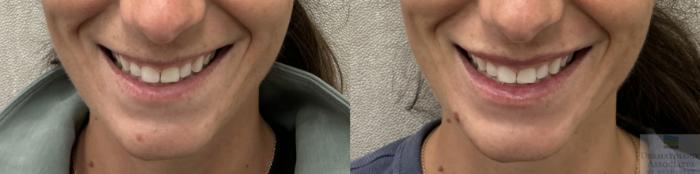 Before & After Neurotoxin Case 138 Front View in Rochester, NY