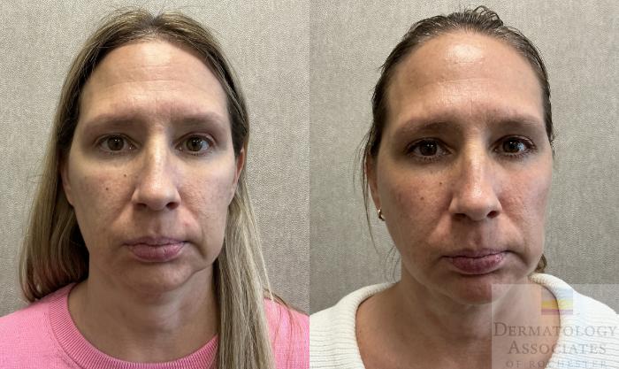 Before & After Halo Tribrid Case 129 Front View in Rochester, NY