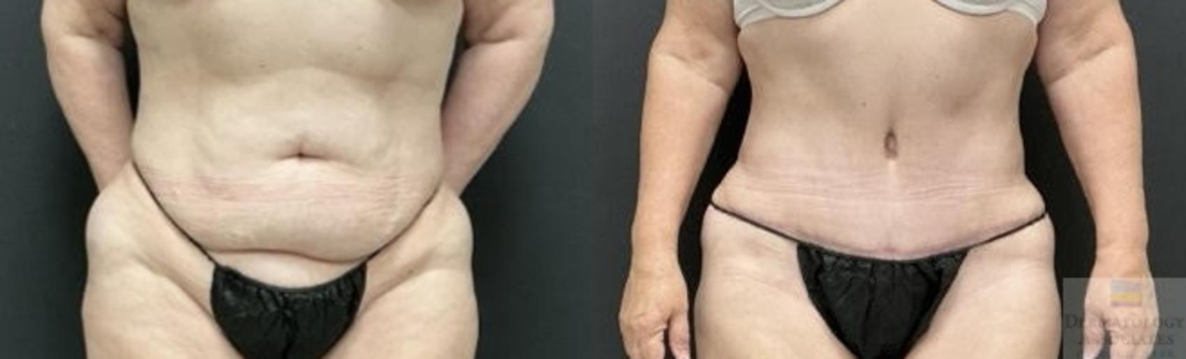 Before & After Abdominoplasty - tummy tuck Case 102 Front View in Rochester, NY