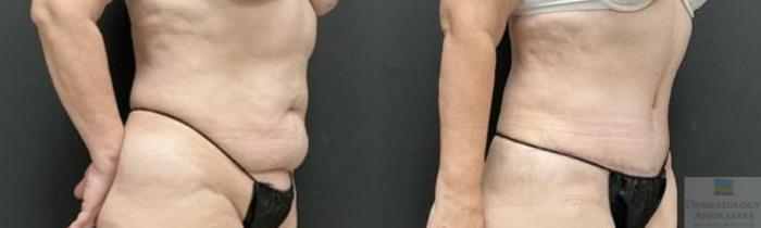Before & After Abdominoplasty - tummy tuck Case 102 Right Side Angle View in Rochester, NY