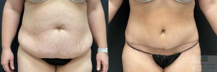 Before & After Abdominoplasty - tummy tuck Case 103 Front View in Rochester, NY