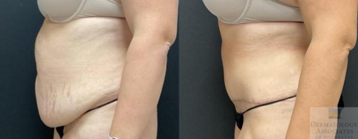 Before & After Abdominoplasty - tummy tuck Case 103 Left Side View in Rochester, NY