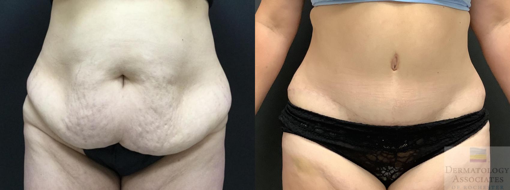 Before & After Abdominoplasty - tummy tuck Case 105 Front View in Rochester, NY
