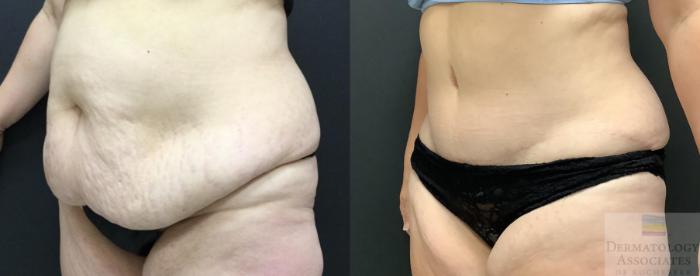 Before & After Abdominoplasty - tummy tuck Case 105 Left Angle View in Rochester, NY