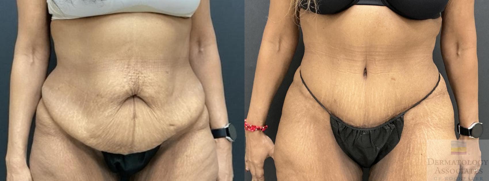 Before & After Abdominoplasty - tummy tuck Case 108 Front View in Rochester, NY