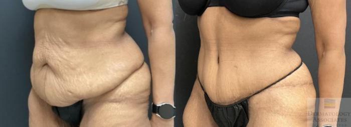Before & After Abdominoplasty - tummy tuck Case 108 Left Side View in Rochester, NY