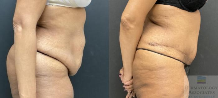 Before & After Abdominoplasty - tummy tuck Case 108 Right Side View in Rochester, NY
