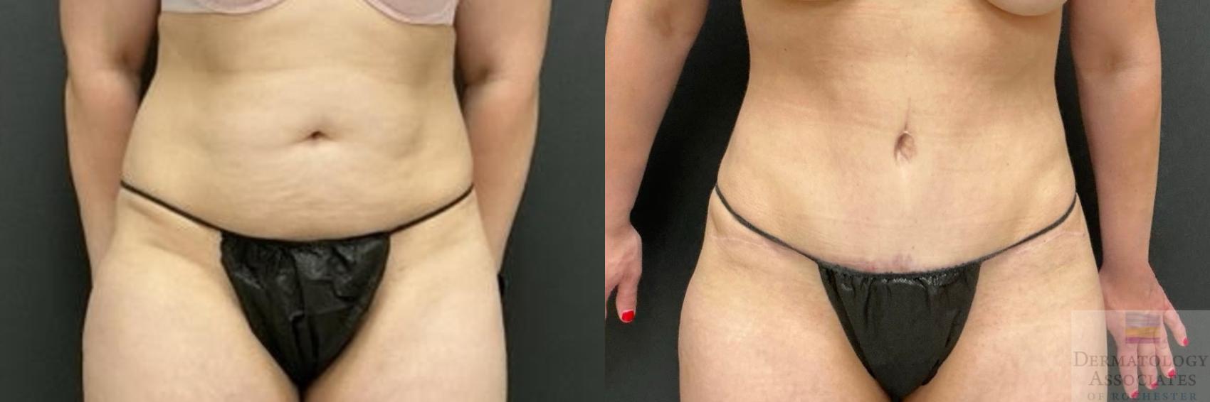 Before & After Abdominoplasty - tummy tuck Case 121 Front View in Rochester, NY