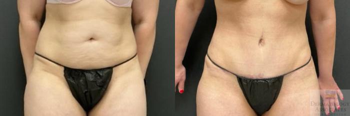 Before & After Abdominoplasty - tummy tuck Case 121 Front View in Rochester, NY