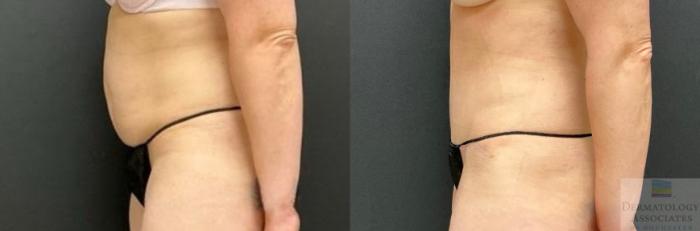 Before & After Abdominoplasty - tummy tuck Case 121 Left Side View in Rochester, NY