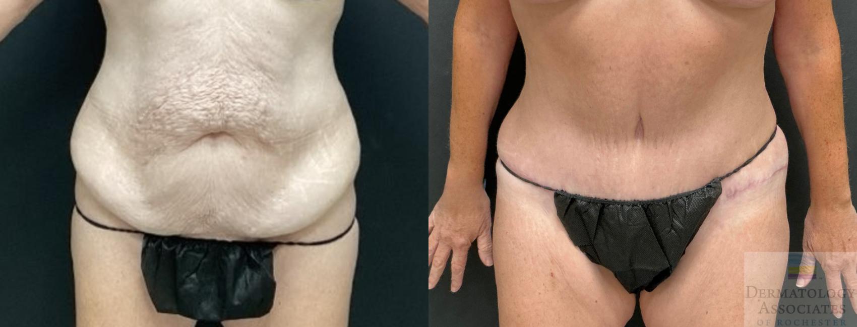 Before & After Abdominoplasty - tummy tuck Case 123 Front View in Rochester, NY