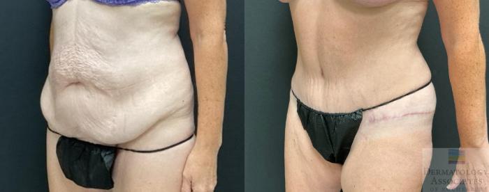 Before & After Abdominoplasty - tummy tuck Case 123 Left Angle View in Rochester, NY