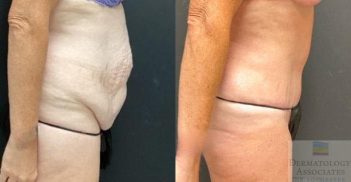 Before & After Abdominoplasty - tummy tuck Case 123 Right Side View in Rochester, NY