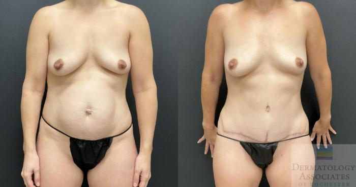 Before & After Abdominoplasty - tummy tuck Case 127 Front View in Rochester, NY
