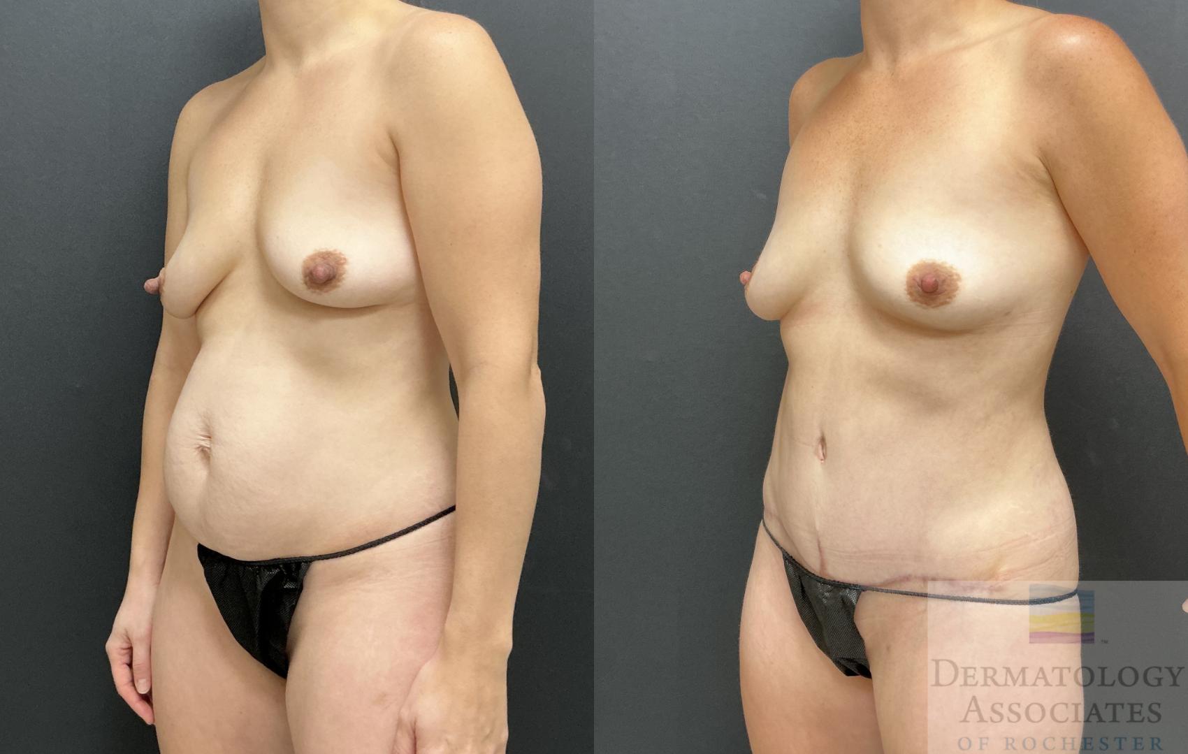 Before & After Abdominoplasty - tummy tuck Case 127 Left Oblique View in Rochester, NY