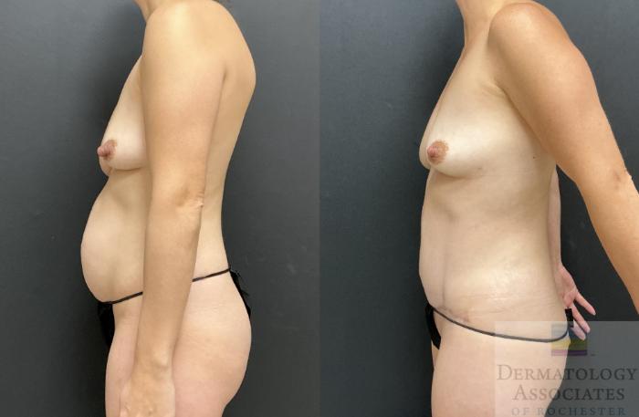 Before & After Abdominoplasty - tummy tuck Case 127 Left Side View in Rochester, NY
