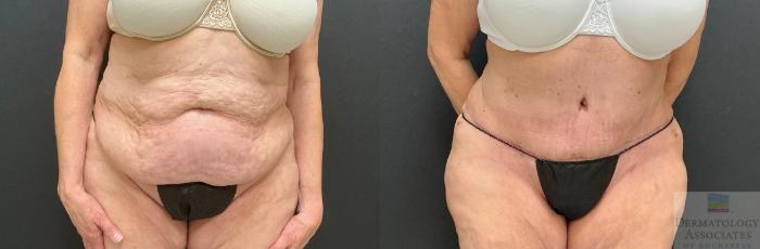 Before & After Abdominoplasty - tummy tuck Case 130 Front View in Rochester, NY