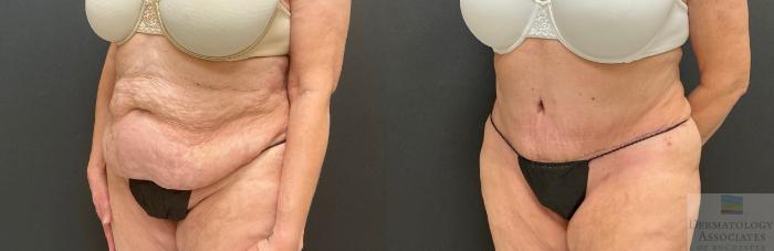Before & After Abdominoplasty - tummy tuck Case 130 Left Oblique View in Rochester, NY
