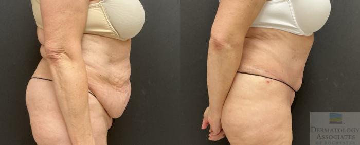 Before & After Abdominoplasty - tummy tuck Case 130 Right Side View in Rochester, NY