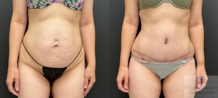 Before & After Abdominoplasty - tummy tuck Case 141 Front View in Rochester, NY