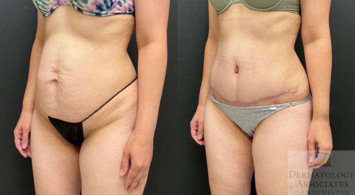 Before & After Abdominoplasty - tummy tuck Case 141 Left Oblique View in Rochester, NY