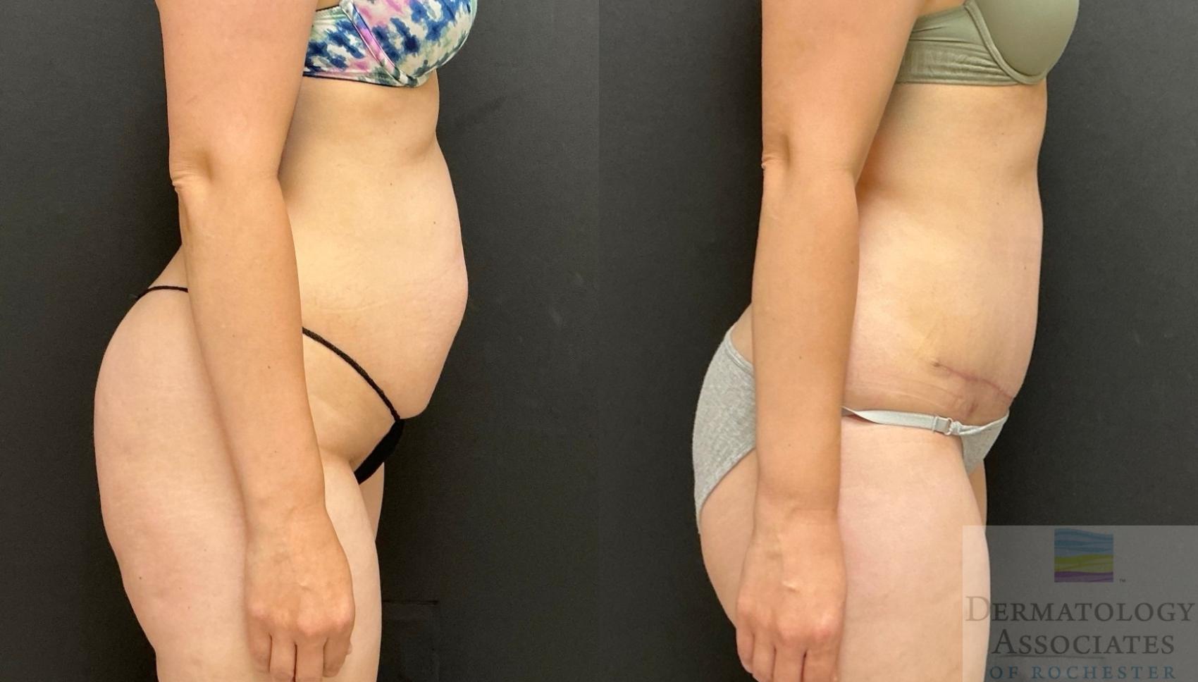 Before & After Abdominoplasty - tummy tuck Case 141 Right Side View in Rochester, NY