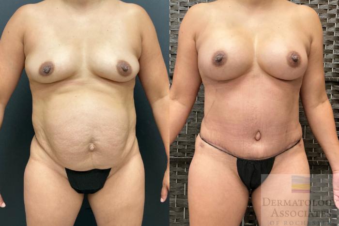 Before & After Abdominoplasty - tummy tuck Case 143 Front View in Rochester, NY