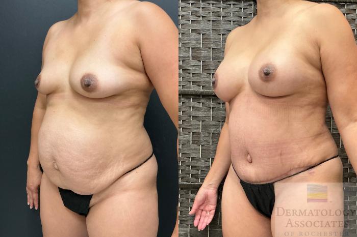 Before & After Abdominoplasty - tummy tuck Case 143 Left Oblique View in Rochester, NY