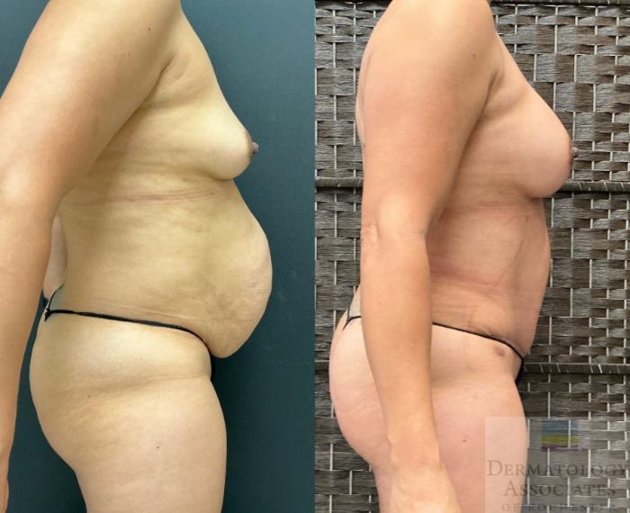 Before & After Abdominoplasty - tummy tuck Case 143 Right Side View in Rochester, NY