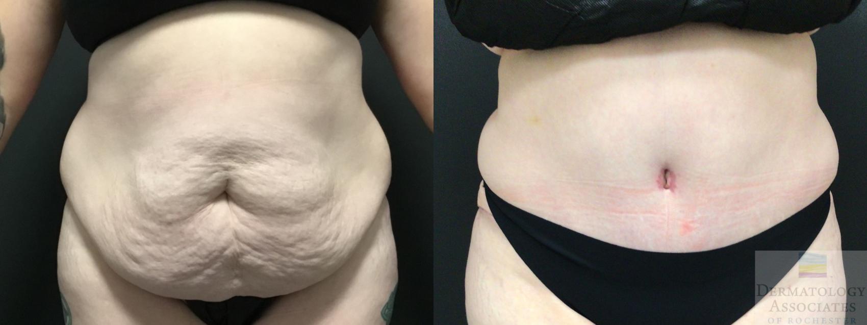 Before & After Abdominoplasty - tummy tuck Case 19 Front View in Rochester, NY