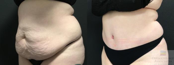 Before & After Abdominoplasty - tummy tuck Case 19 Left Oblique View in Rochester, NY
