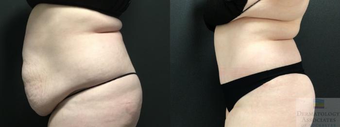 Before & After Abdominoplasty - tummy tuck Case 19 Left Side View in Rochester, NY