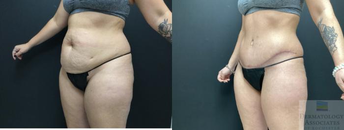 Before & After Abdominoplasty - tummy tuck Case 38 45 Degree Angle View in Rochester, NY