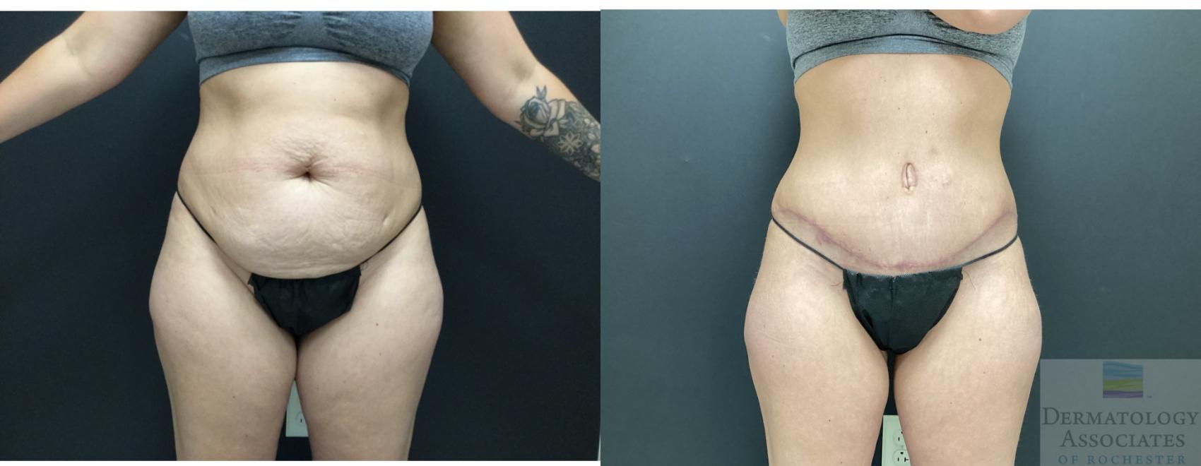 Before & After Abdominoplasty - tummy tuck Case 38 Front View in Rochester, NY