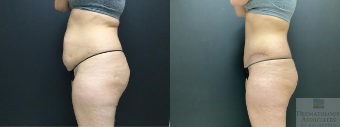 Before & After Abdominoplasty - tummy tuck Case 38 Left Side View in Rochester, NY