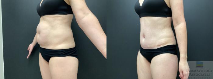 Before & After Abdominoplasty - tummy tuck Case 41 45 Degree Angle View in Rochester, NY