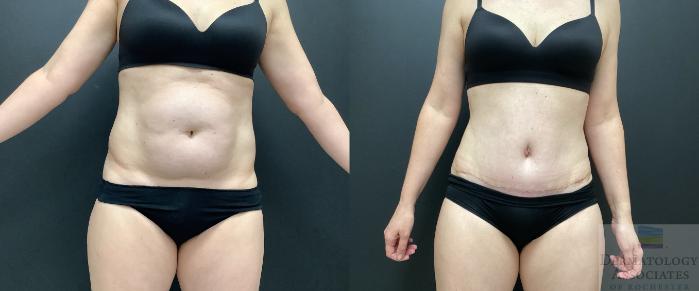 Before & After Abdominoplasty - tummy tuck Case 41 Front View in Rochester, NY