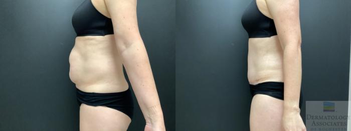 Before & After Abdominoplasty - tummy tuck Case 41 Left Side View in Rochester, NY