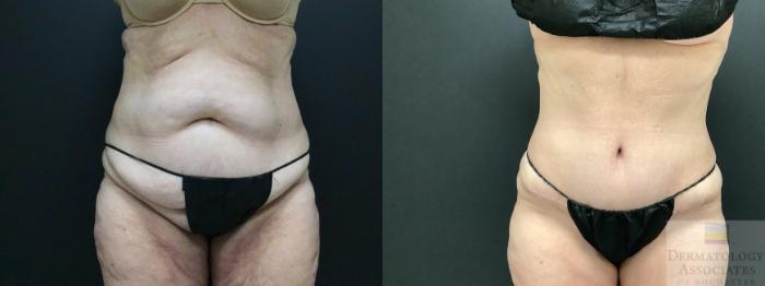 Before & After Abdominoplasty - tummy tuck Case 5 Front View in Rochester, NY