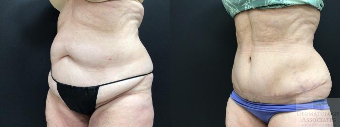 Before & After Abdominoplasty - tummy tuck Case 5 Left Oblique View in Rochester, NY