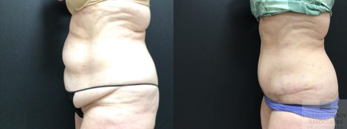 Before & After Abdominoplasty - tummy tuck Case 5 Left Side View in Rochester, NY